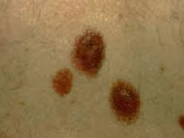 melanoma