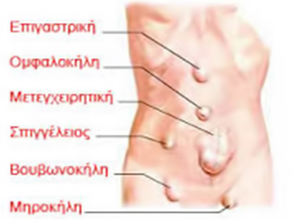 Τι είναι η κήλη;
